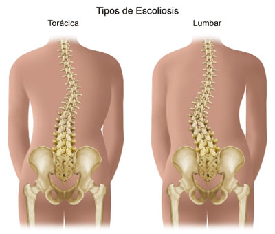 Escoliosis